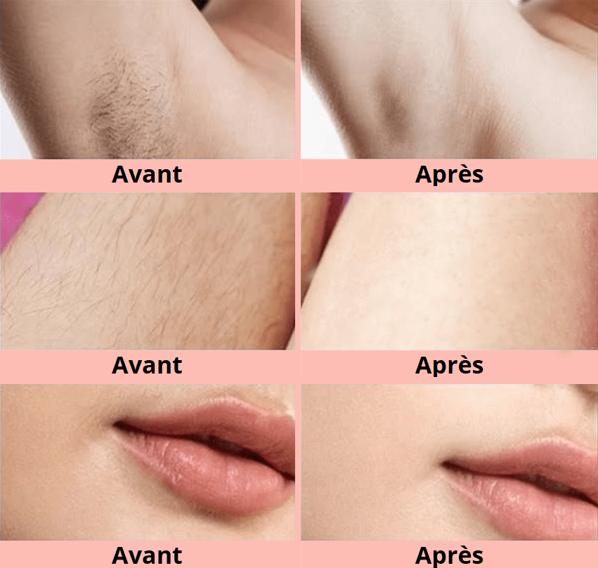 Épilateur à lumière pulsée TechBeautyHome™